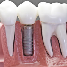 Capped Implant Group Qualident Montrea